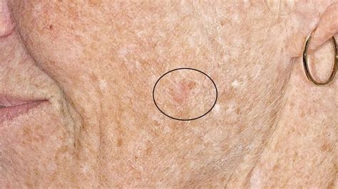 myskin Hautkrebs durch Früherkennung dauerhaft heilen