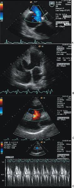 Eisenmenger Syndrome | Thoracic Key