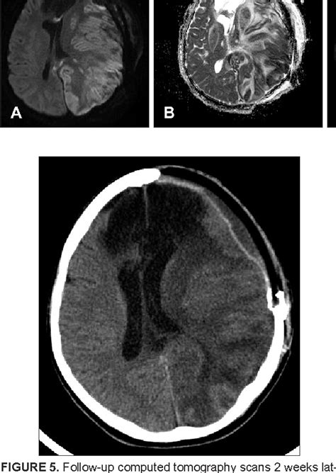 Pdf Intracerebral Hemorrhagic Infarction After Cranioplasty In A Patient With Sinking Skin