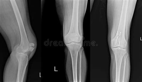 X Ray Left Knee Lateral Showing Kneecap Fracture And Post Operation