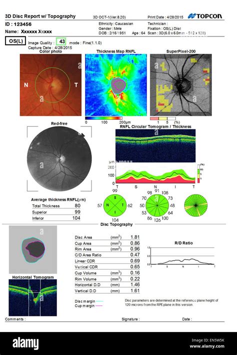 Eye Scan Ultra Sound Test Showing 3d Macula Report Of Human Eye Vist