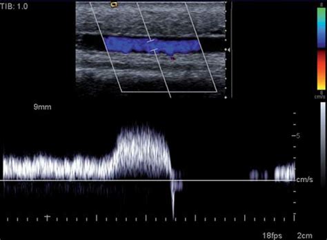 Duplex Ultrasound Technical Considerations For Lower, 60% OFF