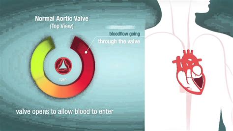 Aortic Stenosis Overview American Heart Association Cpr And First Aid