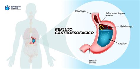 Cirug A Para El Reflujo Gastroesof Gico Bogot Dr Camilo Ortiz Silva