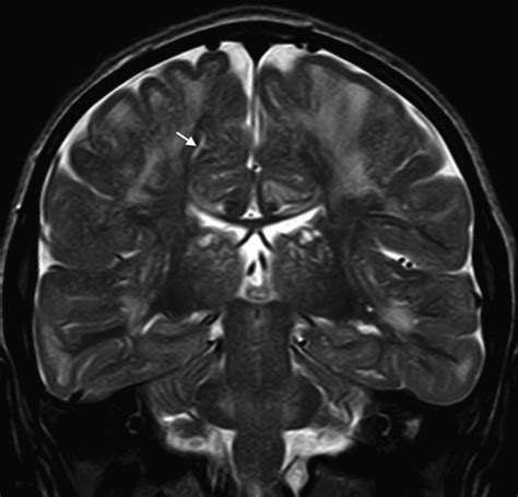 T2 Weighted Coronal Plane Mri Fse T2 Note The Hyperintense Signals