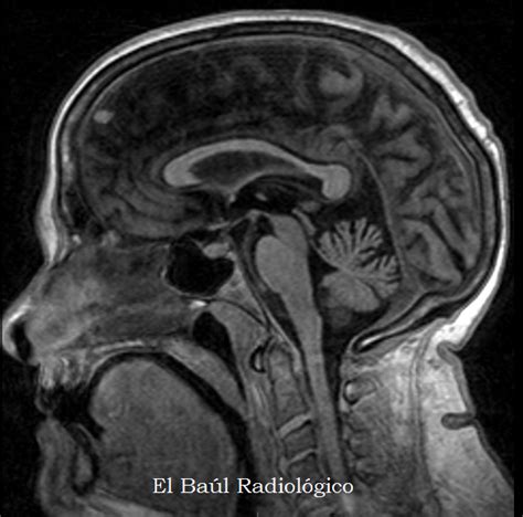 El Ba L Radiol Gico Atrofia Del Cuerpo Calloso Hallazgos En Tc E Irm