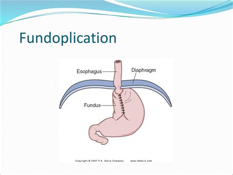 Nursing Care Of Patients With Upper Gastrointestinal Disorders Ppt