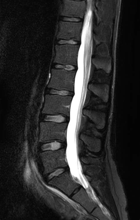 IRM Du Rachis Radiologie Infiltration Ch