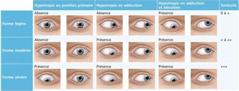 Paralysie Du Moteur Oculaire Commun Ophtalmologie