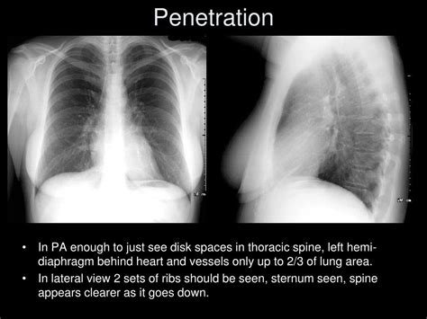 Ppt The Complete Idiot’s Guide To Reading The X Ray Powerpoint Presentation Id 583063