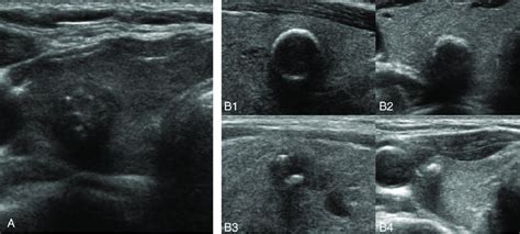 Transverse Ultrasound Image Of Thyroid Nodules With Calcifications A