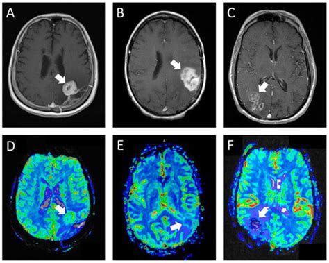 Tomography Free Full Text Perfusion Weighted Imaging The Use Of A