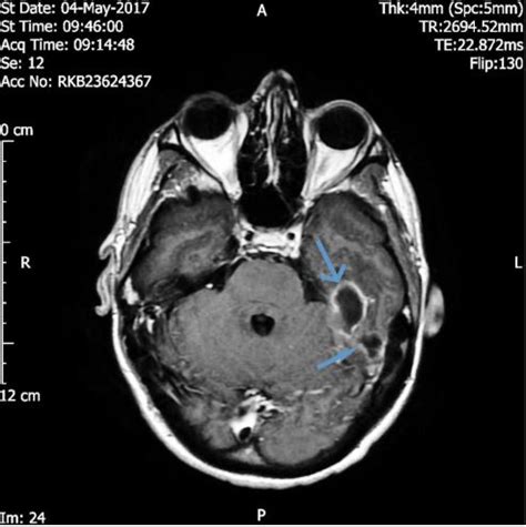 A Man Cleaned His Ears with a Cotton Swab. Then He Got an Infection in His Skull. | Live Science