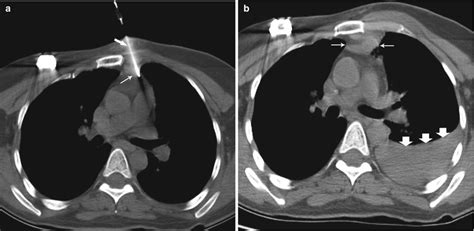 Biopsy of Mediastinal Lesions | Radiology Key