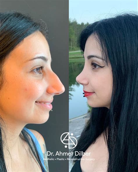 Rhinoplasty Result Dr Ahmet Dilber Rhinoplasty Nose Job Big Nose