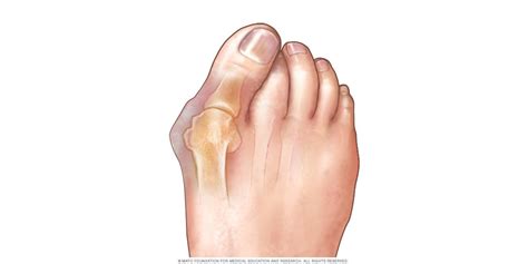 Overlapping Toes - The Complete Guide - Vive Health