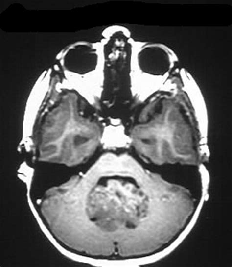 Medulloblastoma