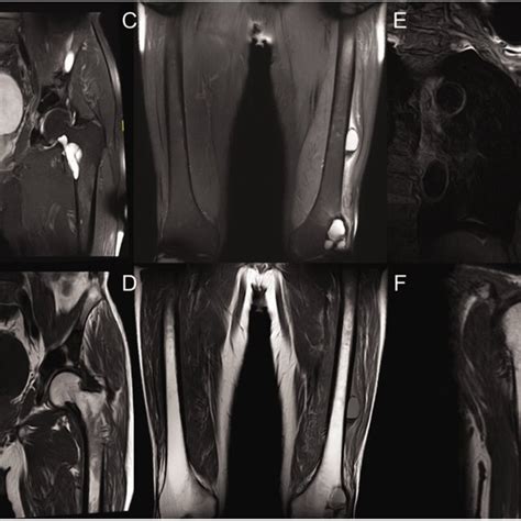 Magnetic Resonance Imaging Of Bilateral Hips Bilateral Femurs And The