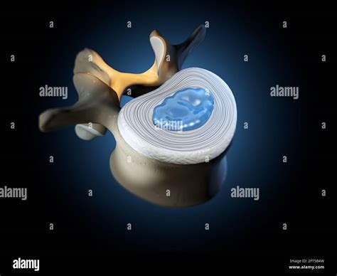 3d Illustration Showing Lumbal Vertebra With Intervertebral Disc And