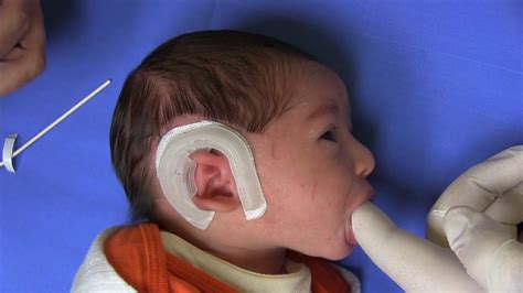 Cup Ear Infant Ear Deformity Corrected With Earwell® Infant Ear