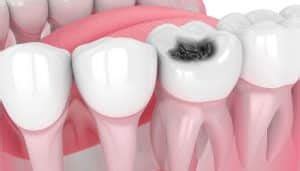 Best Treatment Options For Dental Cavities - Vistadent