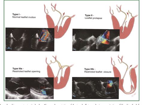 Figure 1 From Review Of Mitral Valve Insufficiency Repair Or