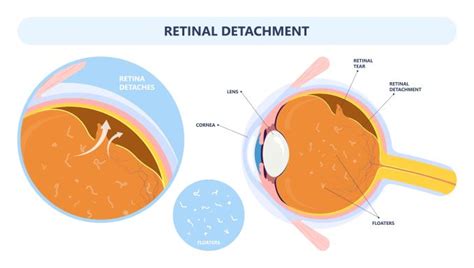 Warning Signs of a Detached Retina | Fort Lauderdale Eye Institute