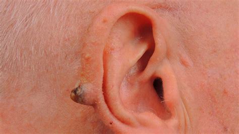 Pictures Of Squamous Cell Carcinoma And Symptoms