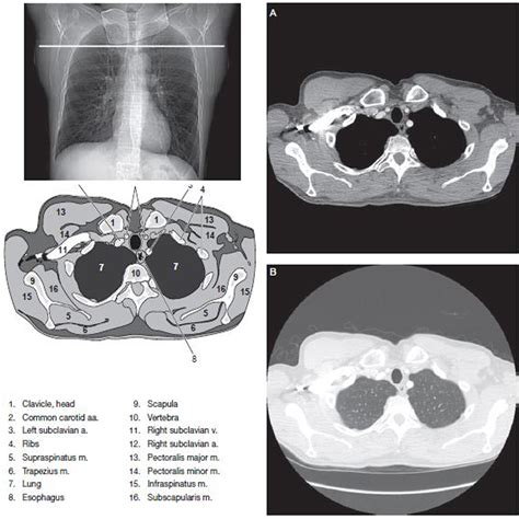 Normal Chest Ct Scan Labeled