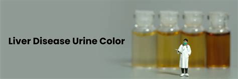 Liver Disease And Urine Colour Changes And Its Causes