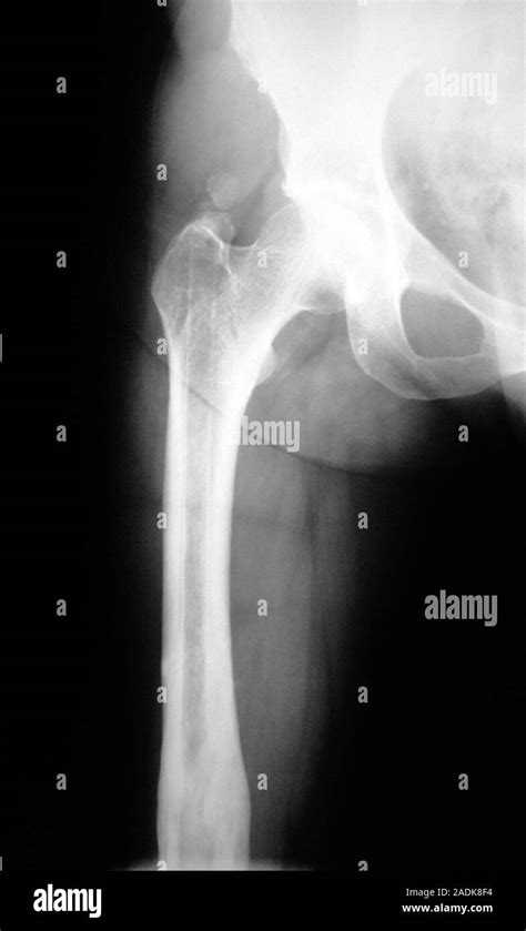 radiografia  femur autologous concentrated bone marrow graft