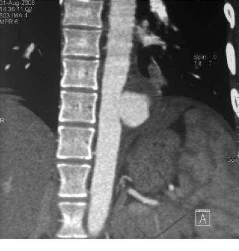 Figure From Pulmonary Edema During Repair Of Mycotic Aneurysm Of