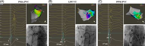 Examples Of Successful Ablation Of Ivas With Crbbb And Superior Axis