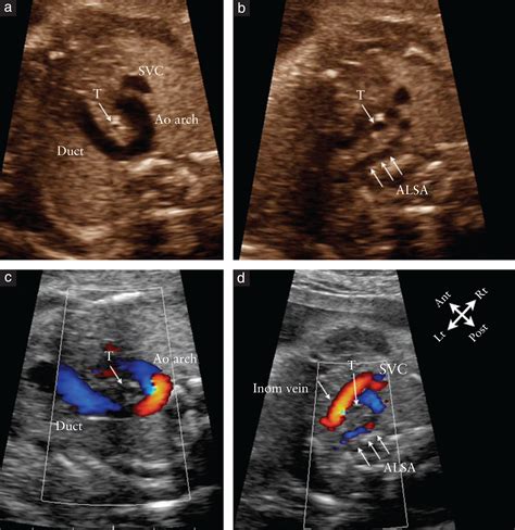 Right Aortic Arch Ultrasound