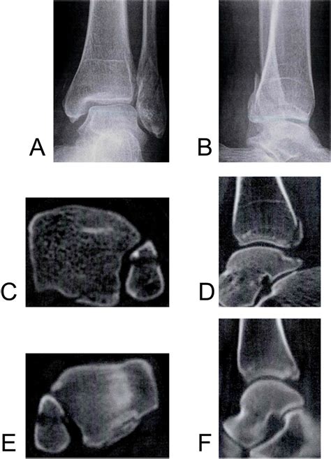 Ct Images Of Different Types Of Posterior Ankle Fractures A Type I