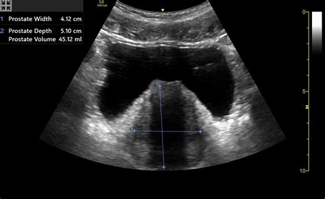 Bladder And Pelvis