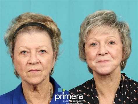 Chemical Peel Before And After Photo Gallery Orlando Tampa Florida