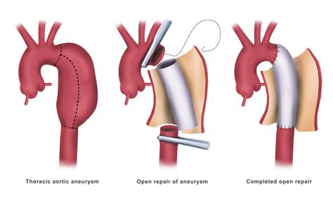 Open Aortic Surgery for Aneurysms - Dubai - Dr. Ahmed Farah