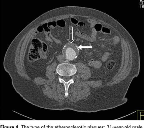 Figure 3 From The Prevalence And Distribution Of The Atherosclerotic