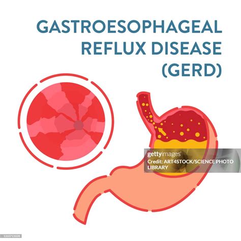 Gastroesophageal Reflux Disease Illustration High Res Vector Graphic Getty Images