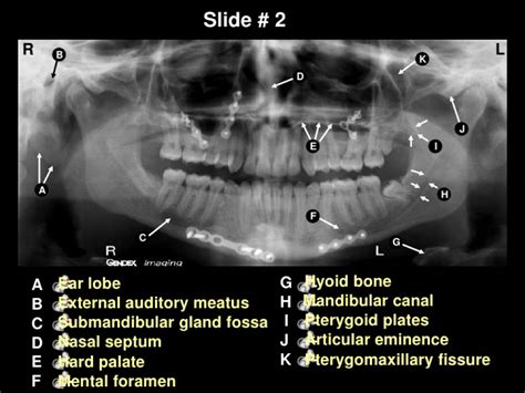 Pin On Teeth Implant