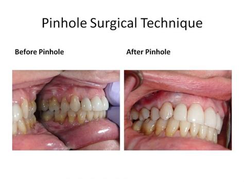 Pinhole Surgery Technique Gum Recession And Pst Geneva Il Dentist