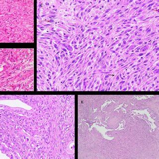 Histopathologic Findings Of Sarcomatoid Carcinoma Of The Pancreas