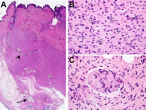 Neurofibroma Histology