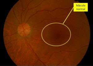 Entender La Degeneraci N Macular Asociada A La Edad Dmae En T Rminos