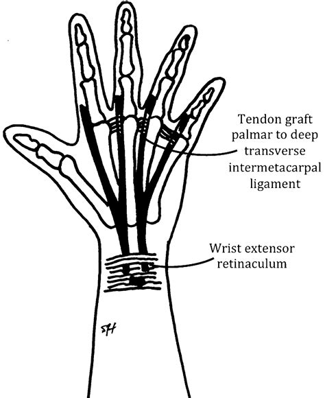 Tendon Transfers For Combined Peripheral Nerve Injuries Hand Clinics