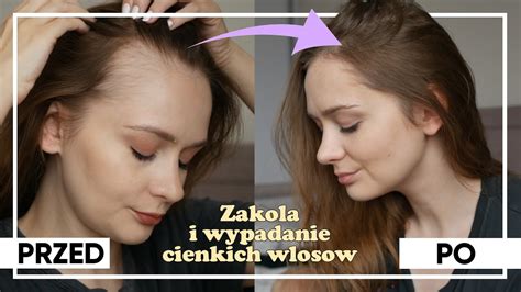 Jak zagęściłam ZAKOLA Cienkie włosy i wypadanie włosów po ciąży