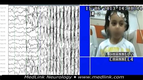 Childhood absence epilepsy (CAE) | MedLink Neurology