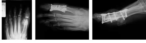 Figure From Modified Bone Block Distraction Arthrodesis Of The Hallux