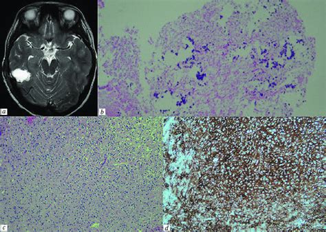 Postoperative Mri Shows A Picture Of Total Resection Of The Tumor And